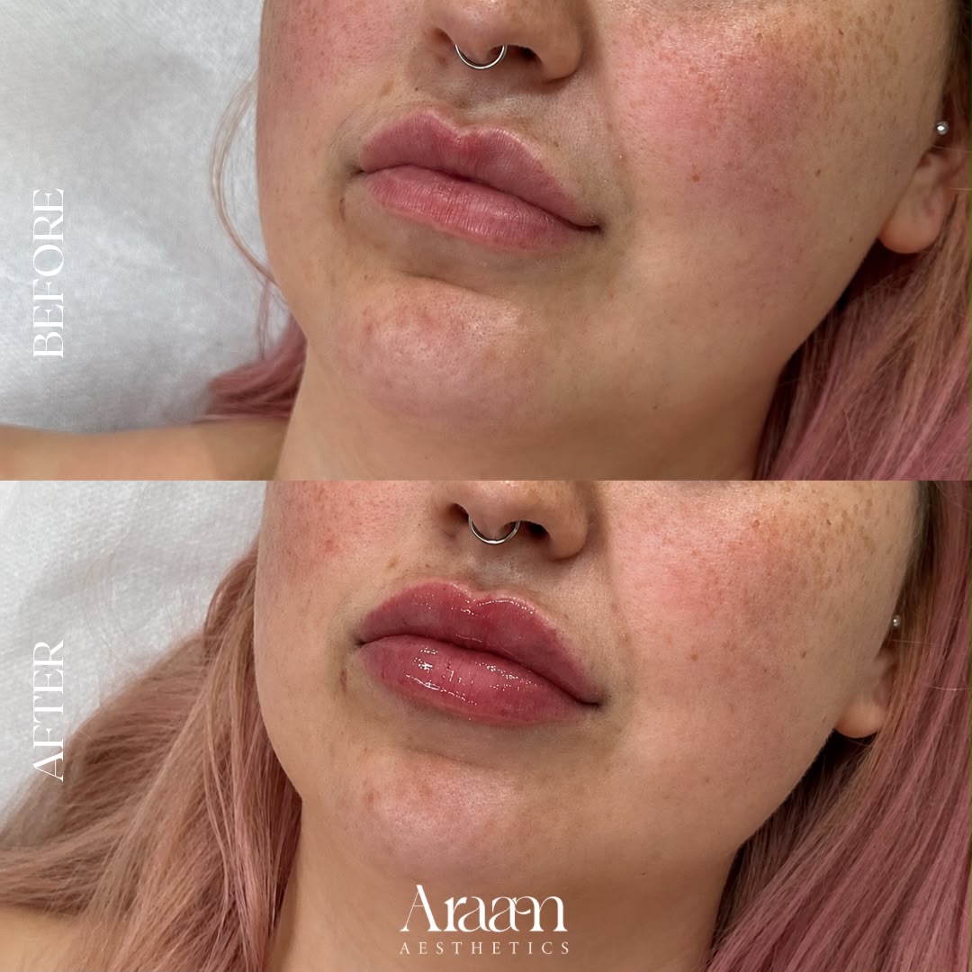 Araam Aesthetics lip filler before and after