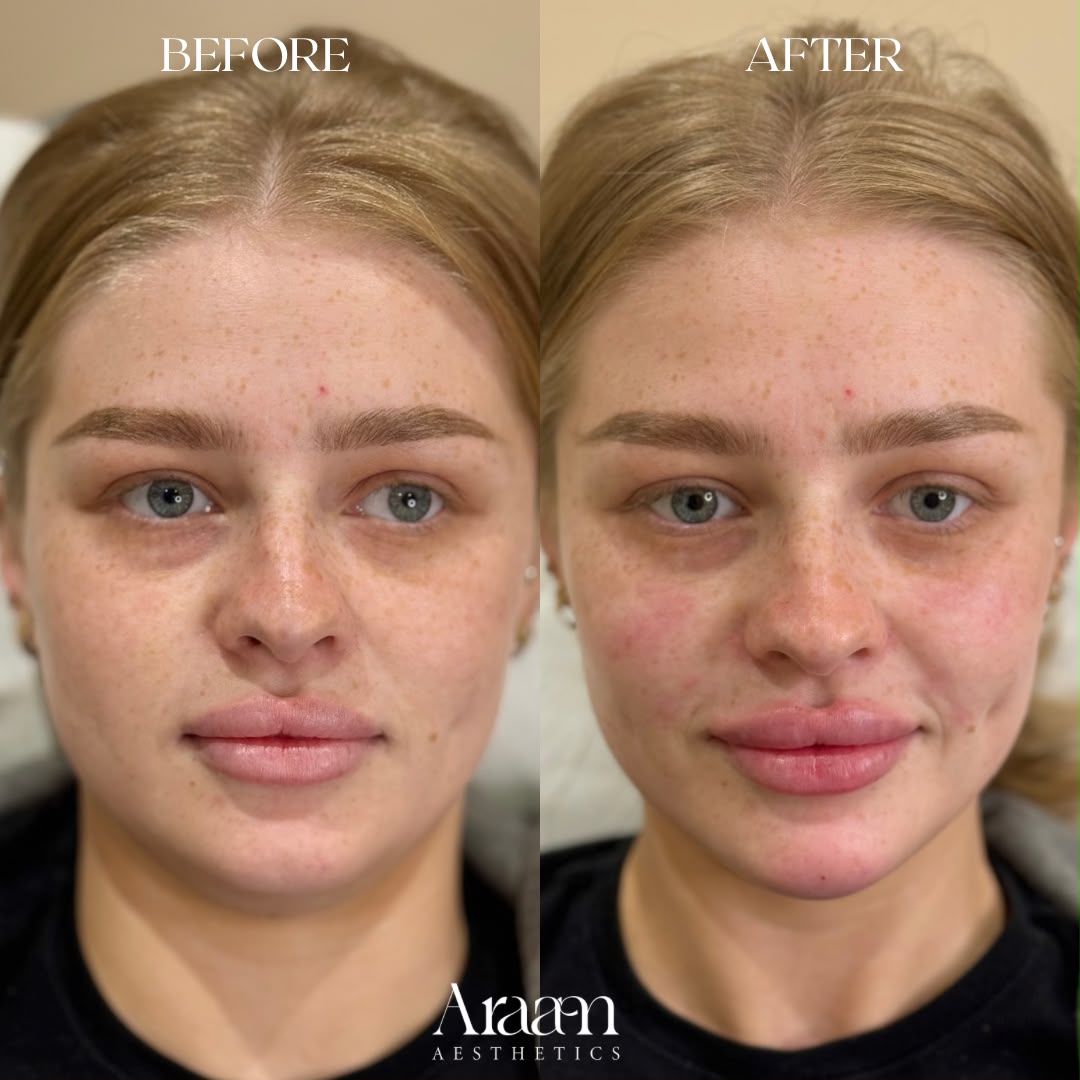 Araam Aesthetics facial balancing before and after