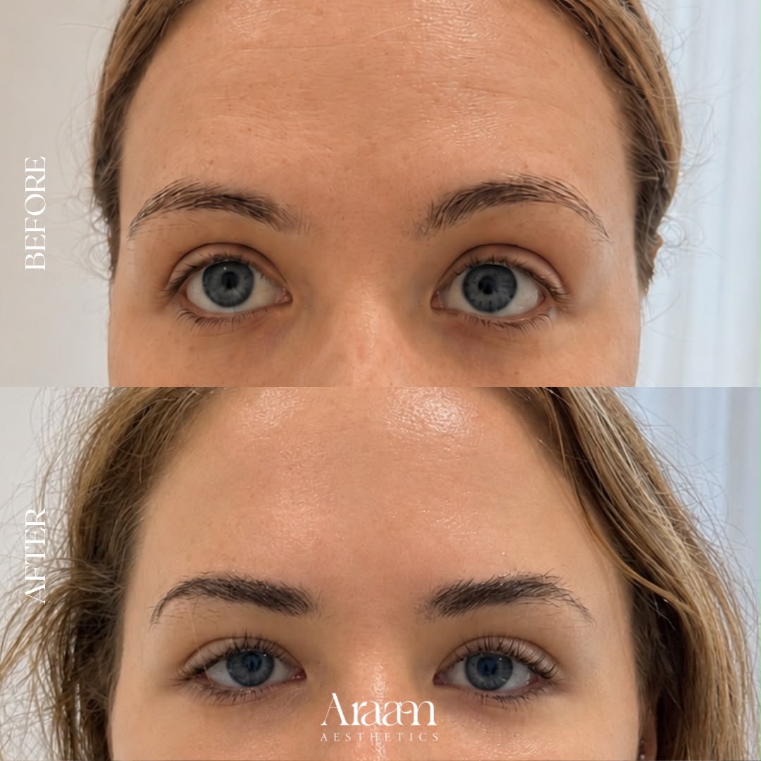 Araam Aesthetics anti-wrinkle forehead before and after