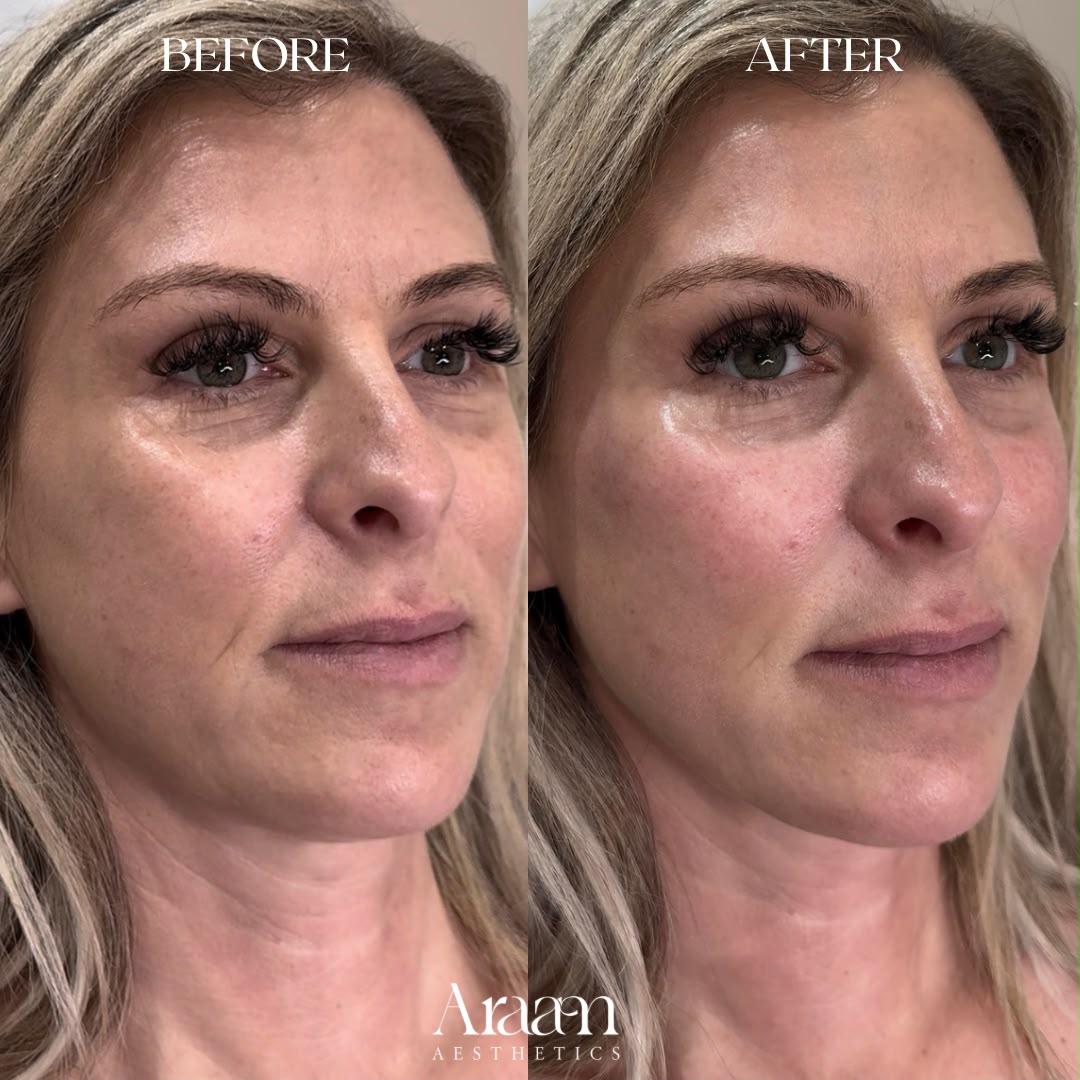 Araam Aesthetics skin rejuvenation before and after