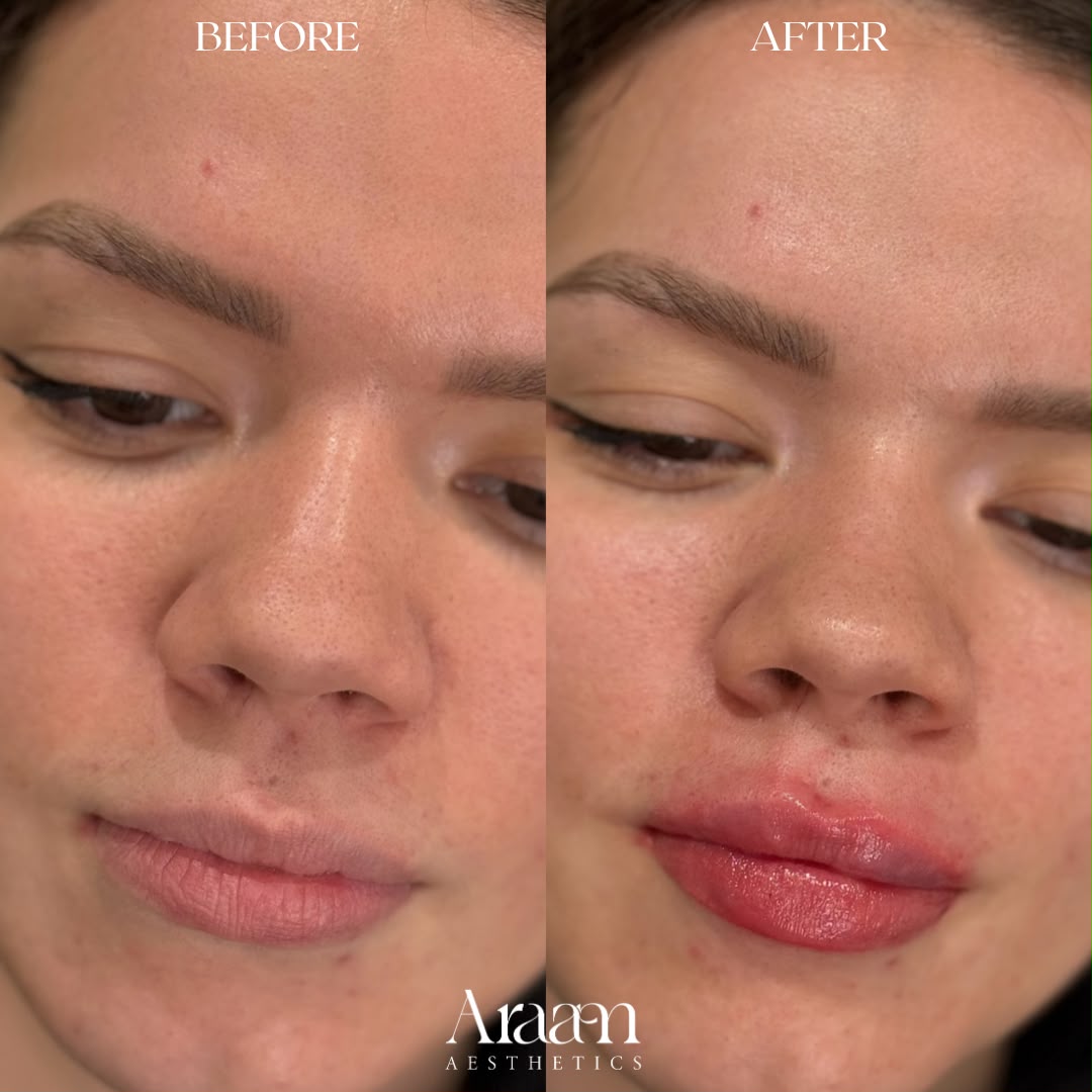 Araam Aesthetics lip filler before and after, side view