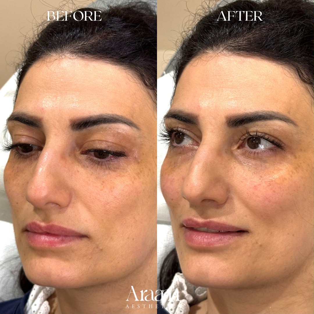Araam Aesthetics non-surgical nose and cheek before and after