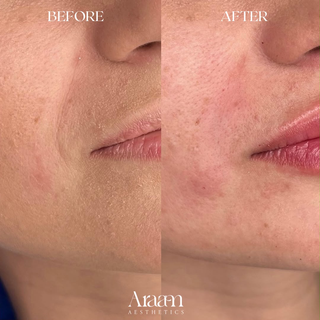 Araam Aesthetics smile line and skin before and after