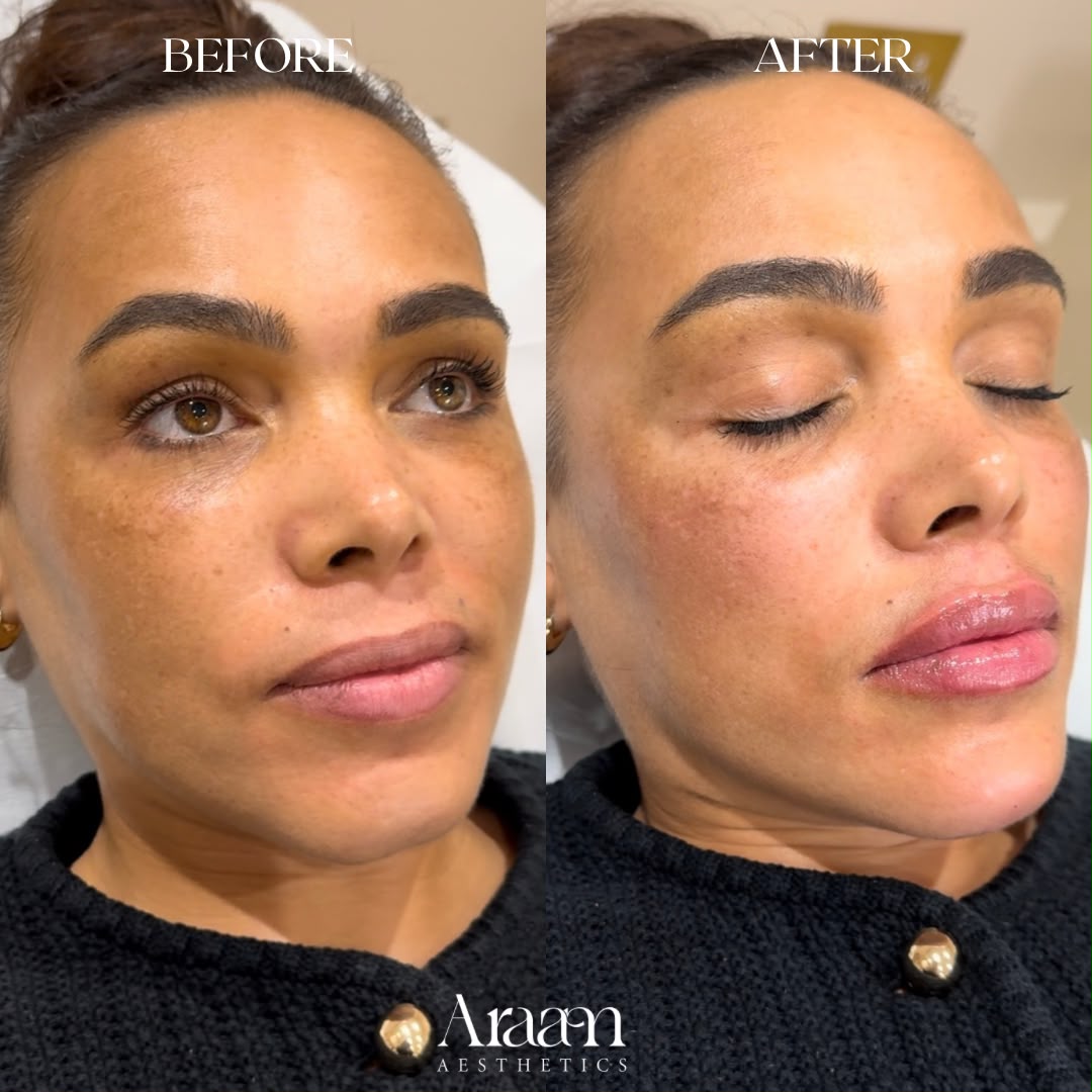 Araam Aesthetics lip and cheek before and after